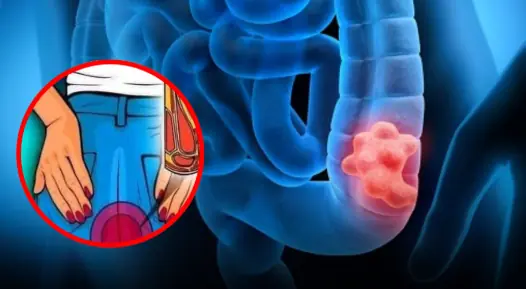 These Everyday Habits Could Quietly Increase Your Risk of Colon Cancer Without You Realizing It