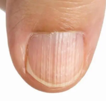 11 Warning Signs Your Fingernails Could Be Revealing About Your Health