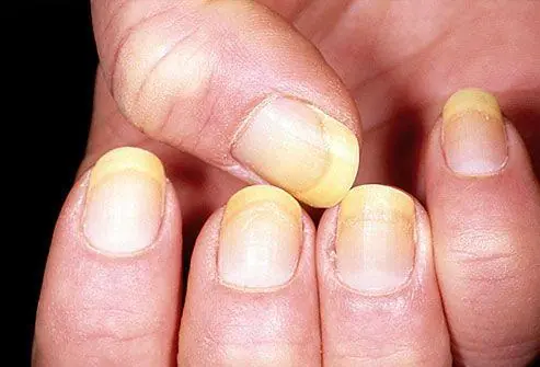 Observe Your Nails to Detect Health Issues — What Doctors Say Your Nails May Reveal