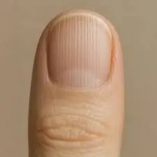 If you have lines on your nails, it means you have ca...