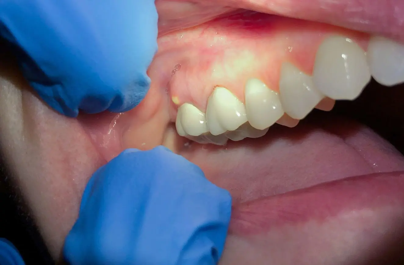 If you notice white bumps in your mouth, here’s what your body may be trying to tell you