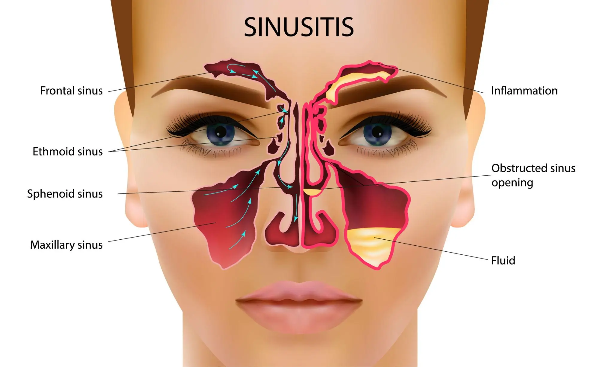 The Real Causes of Constant Phlegm and Mucus in the Throat — And How to Get Rid of It