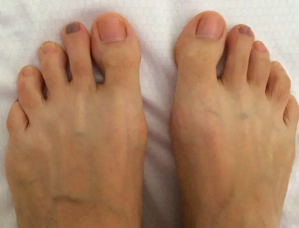 Black Toenail? Here’s What It May Mean — And What You Should Do