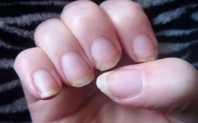 Look at Your Nails: These 3 Warning Signs Could Reveal Hidden Health Problems