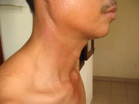 Massive Jugular Distension Explained: Causes You Shouldn’t Ignore