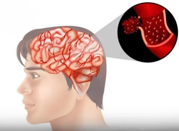 4 Common Morning Habits That May Increase Stroke Risk, According to Experts