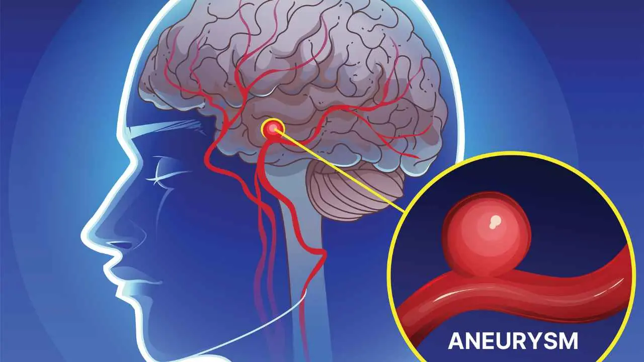 Doctors Warn: These Symptoms Could Signal an Aneurysm