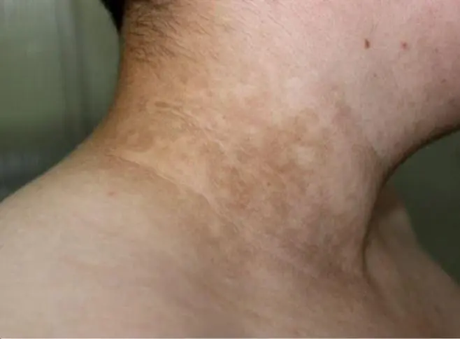 Your skin could be sending silent signals: these 12 changes are often linked to diabetes…