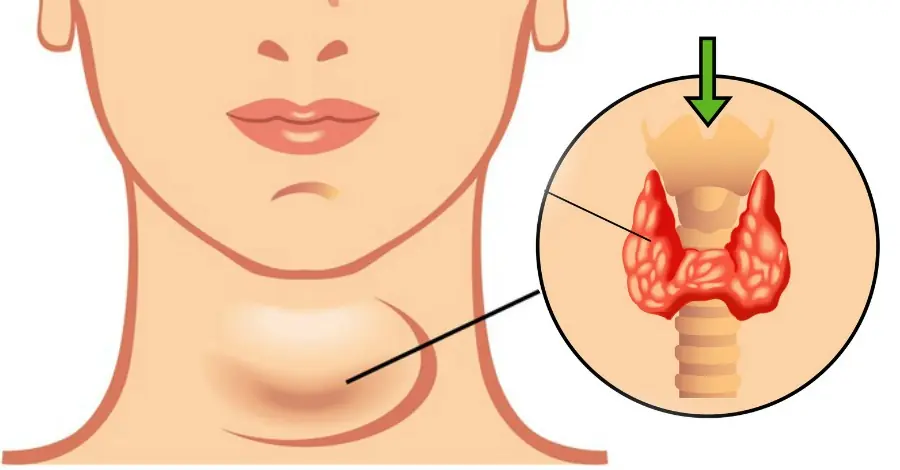 36-Year-Old Woman Lived a Healthy Lifestyle but Still Developed Hypothyroidism — Doctors Say These 4 Popular Foods May Need to Be Limited