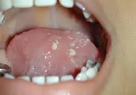 Tiny White Bumps Inside the Mouth May Be Telling You Something