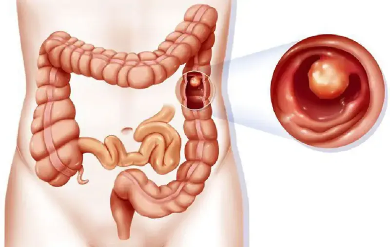 Don’t Ignore These 6 Possible Early Signs of Colon Can.cer