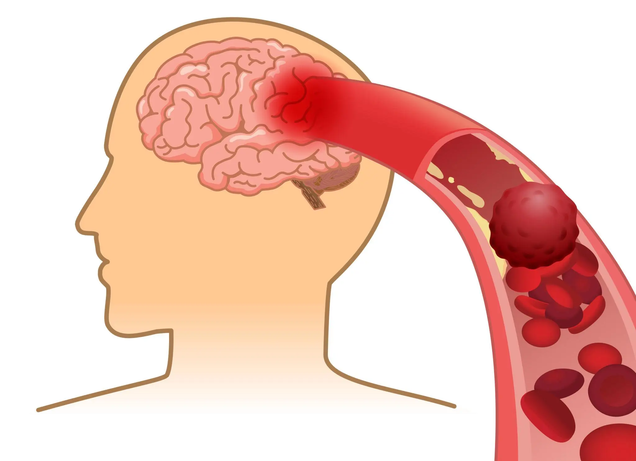 These 10 Unusual Symptoms May Be Early Signals of Stroke Risk
