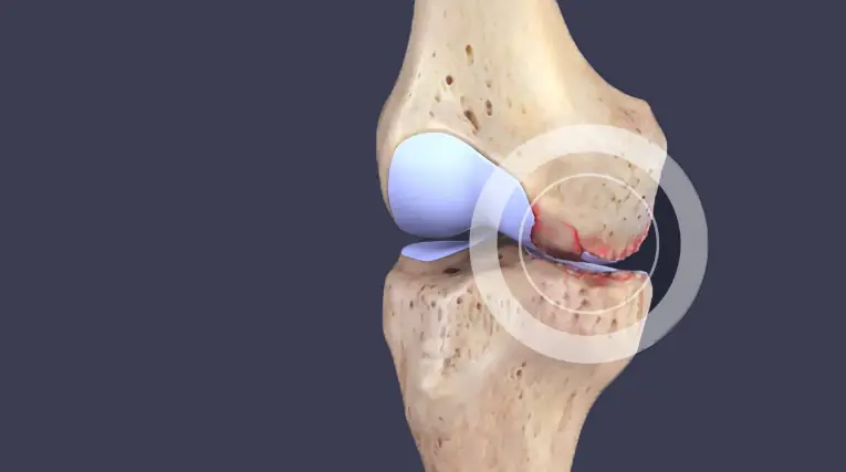 These 6 Nutrients May Help Reduce Knee Pain and Improve Joint Function