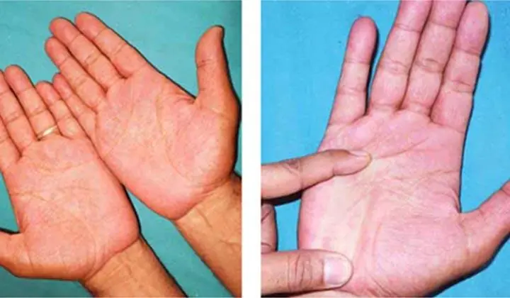 People With Liv.er Problems Often Show These 3 Signs on Their Hands, Doctors Warn