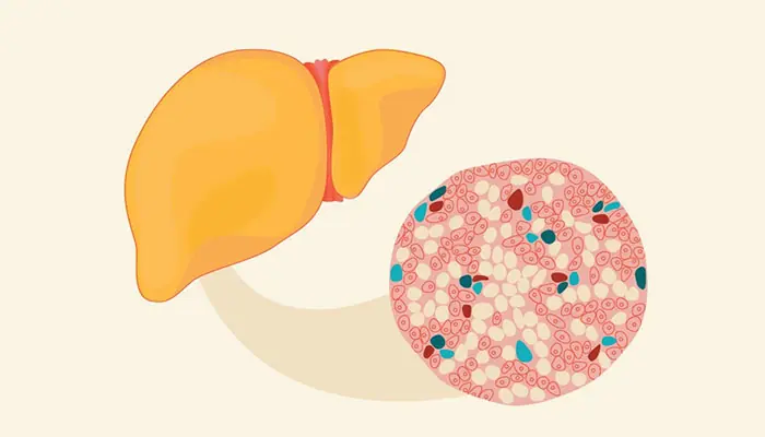 Fatty Liver Disease May Begin Quietly - Here Are 7 Warning Signs to Watch For