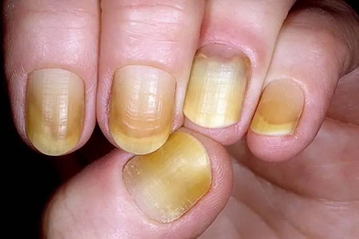 These 7 Nail Symptoms May Be Your Body’s Way of Signaling Health Concerns