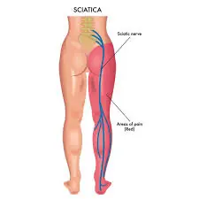 Instant Sciatica Pain Relief? This Simple Technique Is Getting Attention for a Reason