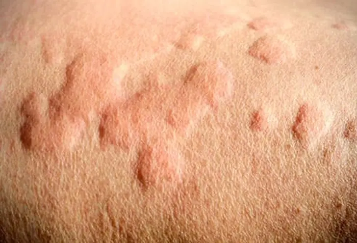 He Thought It Was Just an Allergy… Until the Constant Itching Revealed Something Much More Serious
