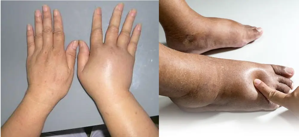 The Truth Behind Swelling in Your Hands and Feet That Many People Overlook
