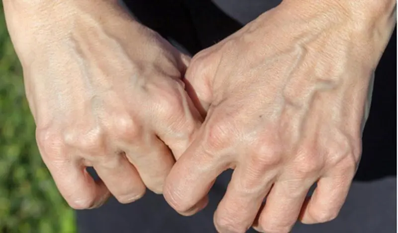 If you have visible veins it means you are...