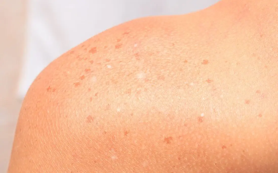 White Spots on Your Arms or Legs? Here’s What Your Body May Be Trying to Tell You