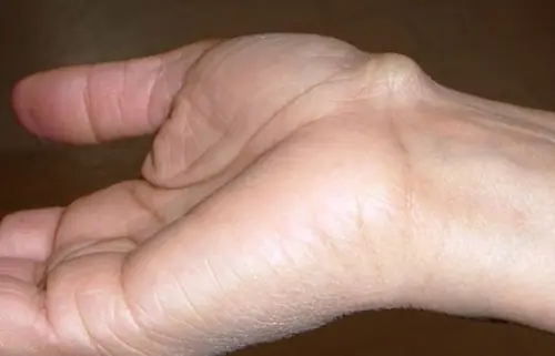 A Small Wrist Bump May Be More Common Than You Think - It Could Be a Ganglion Cyst