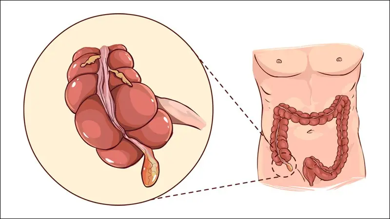 These 9 Symptoms Could Be Signs of Appendicitis - Know Them Early