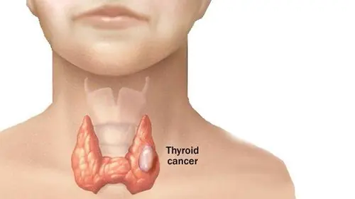 Thyroid Cancer Warning: 7 Early Signs Your Body May Be Showing