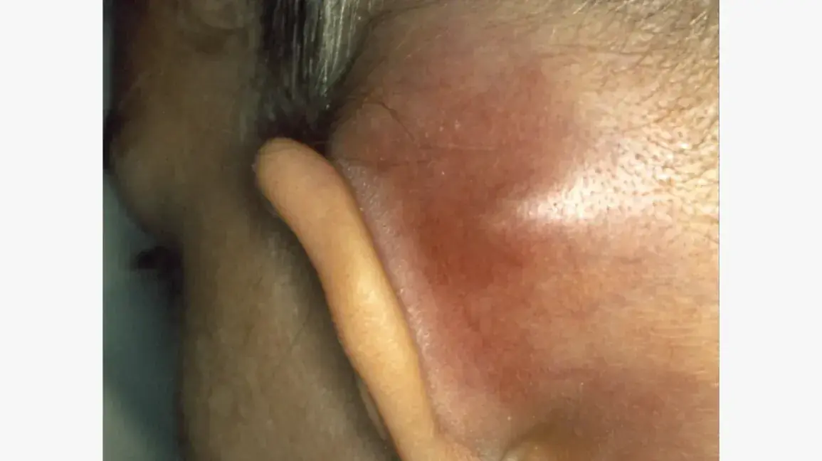 A Lump Behind the Ear or on the Neck Could Be a Sign You Shouldn’t Ignore