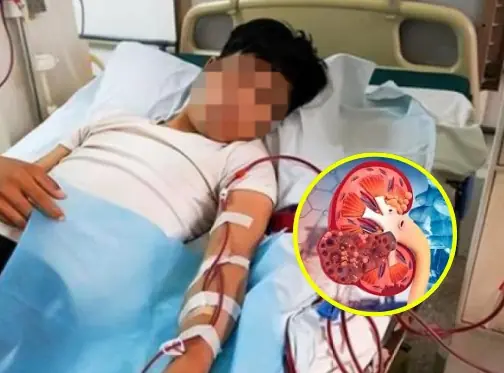 22-Year-Old Man Dia.gno.sed With Kid.ney Fail.ure and Dia.be.tes at the Same Time: Doctors Say the Risk Came From 3 Bad Habits