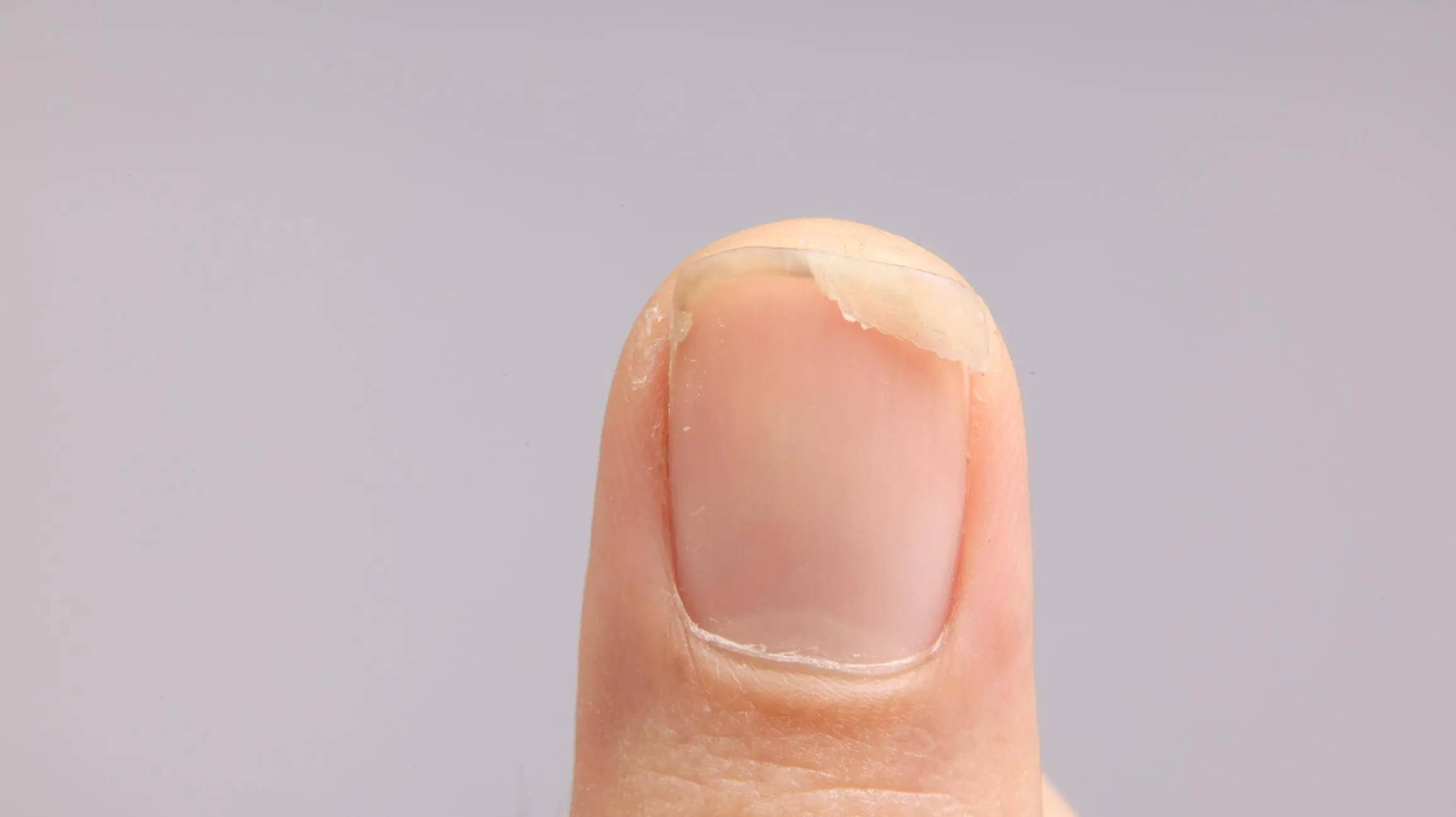 Why Do Fingernails Split Straight Down Instead of Chipping?