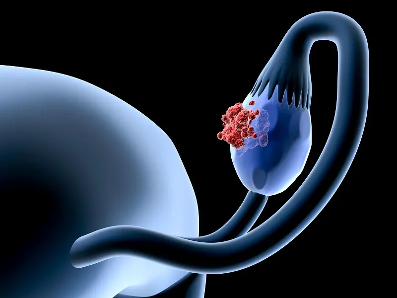 Ovarian Can.cer May Develop Quietly - Here Are the Warning Signs to Watch For