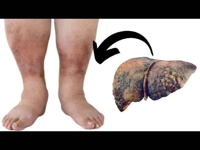 10 shocking signs of fatty liver you must never ignore!