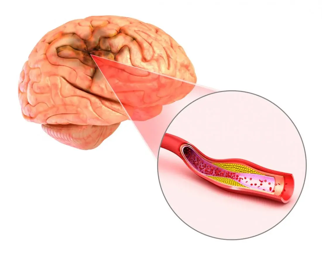 These Aneurysm Symptoms May Seem Harmless at First