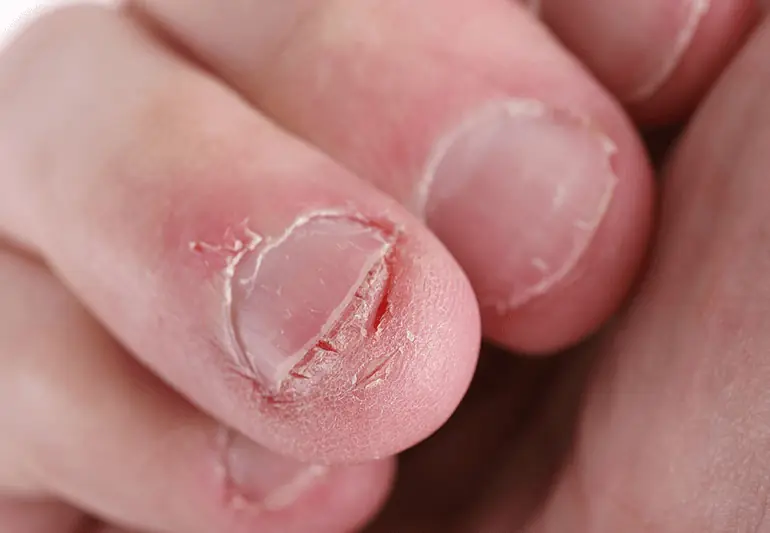 These 9 Nail Changes Could Be Warning Signs Your Body Is Trying to Send You