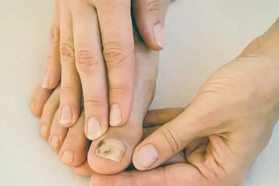 Can.cer Can Affect More Than Internal Organs - Here Are 3 Changes That May Appear in the Limbs