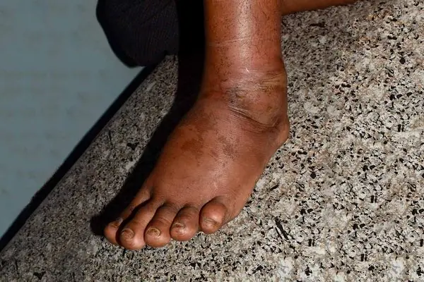 Swollen legs aren't always caused by standing too long — they could signal an underlying health problem