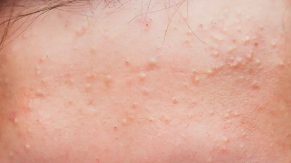 If You Notice Small White Bumps on Your Skin, Think Twice Before Trying to Remove Them