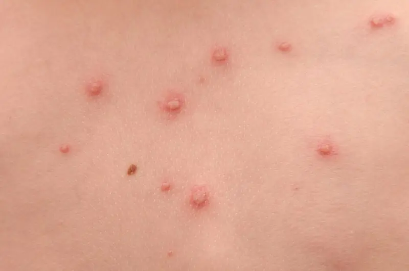 These Pa.inful Bli.sters Could Be a Warning Sign of Shingles - Don't Ignore Them.