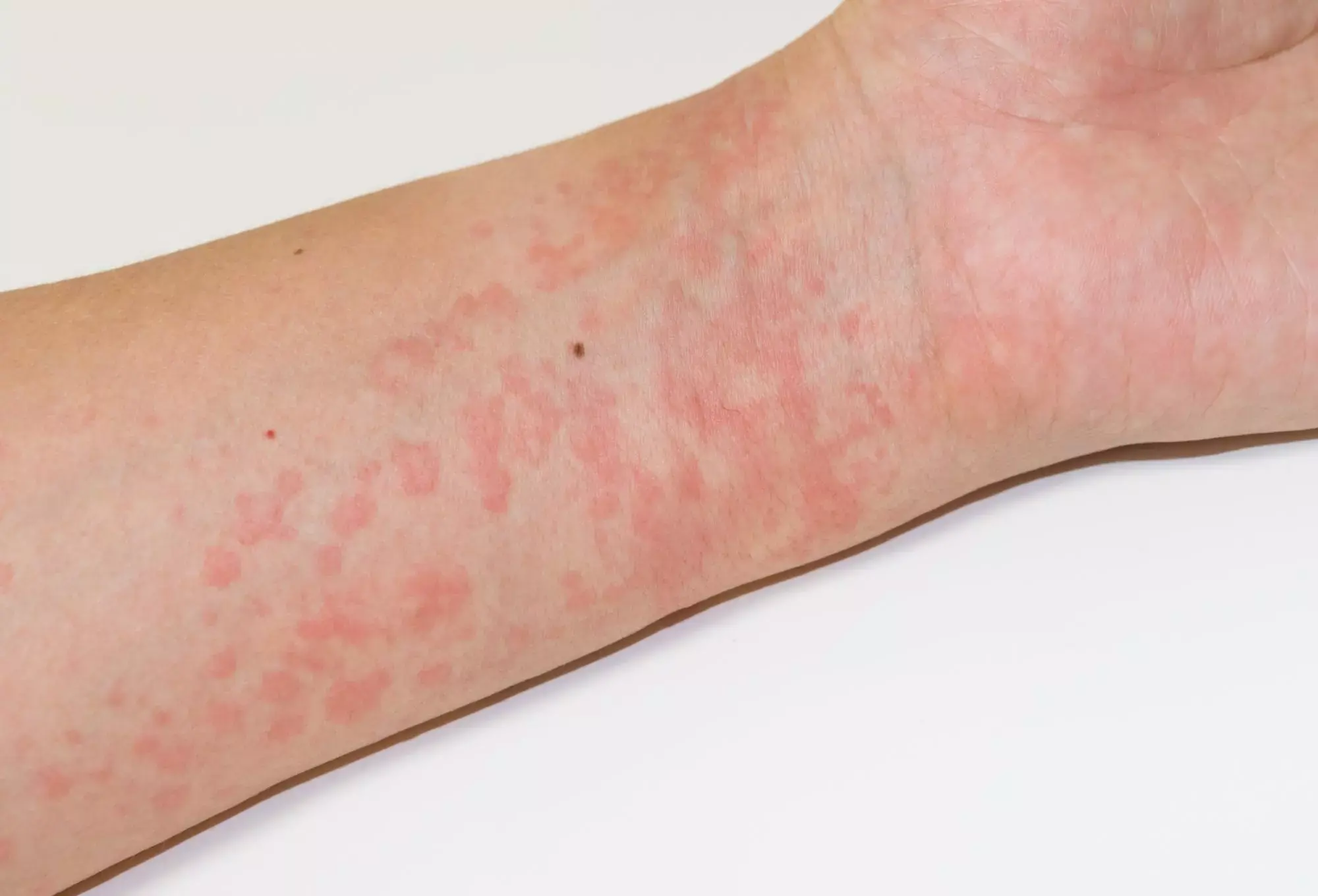 Recurring Hives? These Unexpected Factors May Be Contributing to Your Symptoms