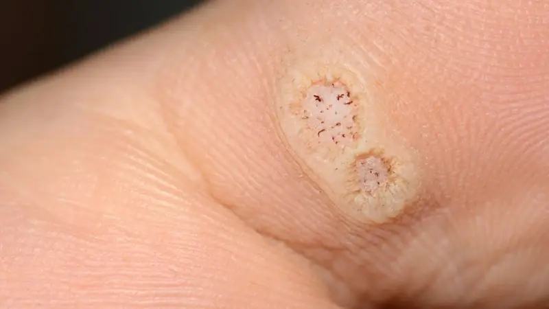 Warts Explained: 6 Different Types, Their Symptoms, and How to Treat Them