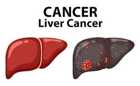 Liver Disease Can Be Silent — Here Are 3 Possible Signs That May Appear Early