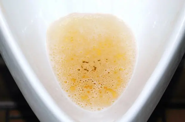 Your Morning Uri.ne Can Reveal Whether Your Body Has Hea.lth Problems