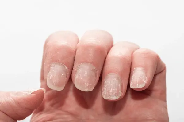 Take a Look at Your Nails: These 9 Changes May Signal Underlying Health Issues