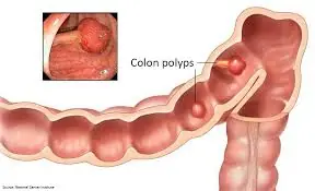 Recommended for a Colonoscopy? Here's How to Make an Informed Decision