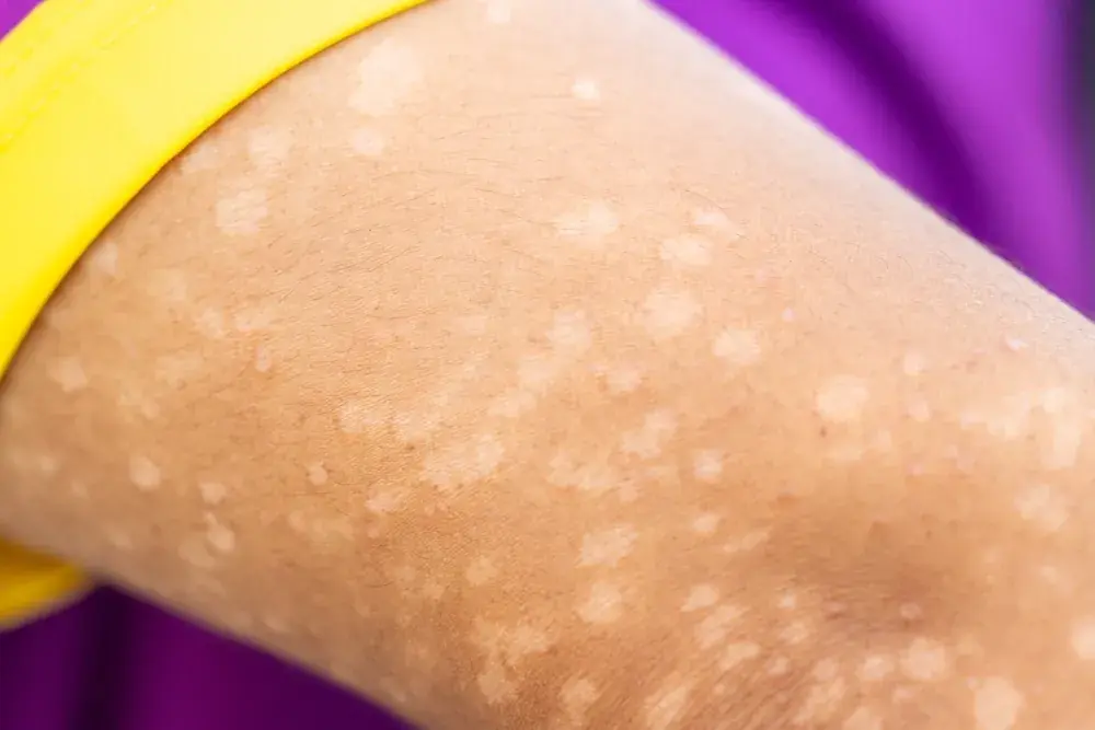 Those Little White Spots on Your Arms or Legs Might Not Be Random