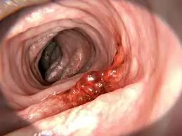 5 Symptoms That Could Signal Colon Cancer and Deserve Medical Attention