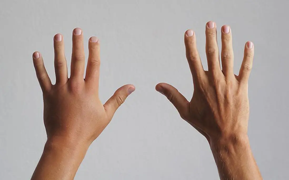 Don't Ignore Pain and Swe.lling in Your Fingers - These Symptoms May Signal a Larger Health Concern.