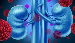 Could It Be Kidney Can.cer? Here Are 7 Symptoms That Deserve Attention