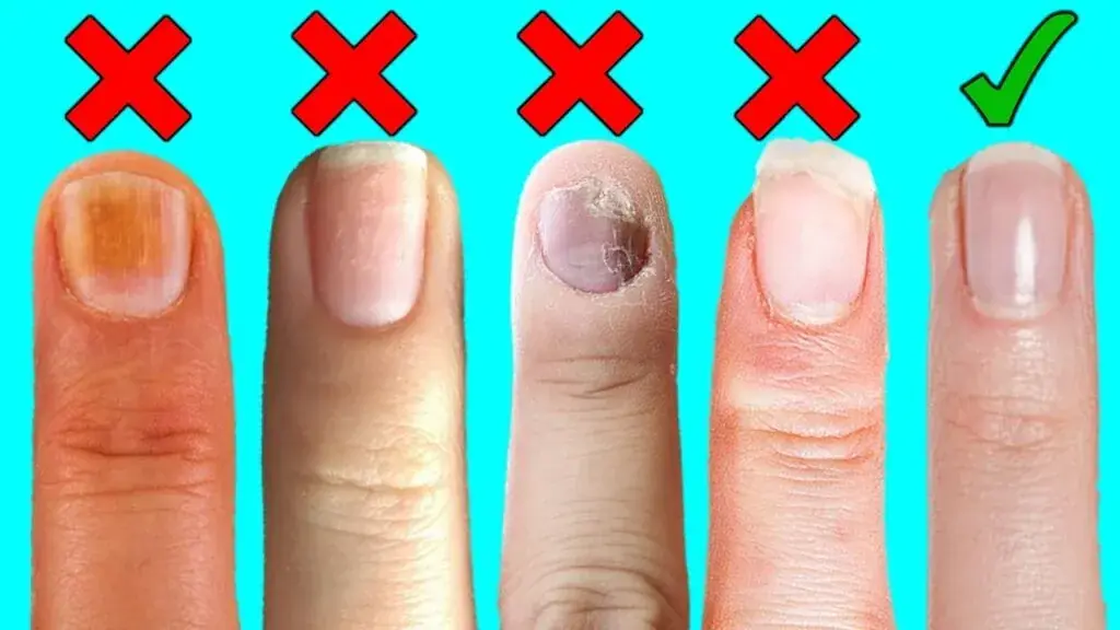 Most People Ignore These Nail Changes — Experts Say They Could Reveal Underlying Health Issues